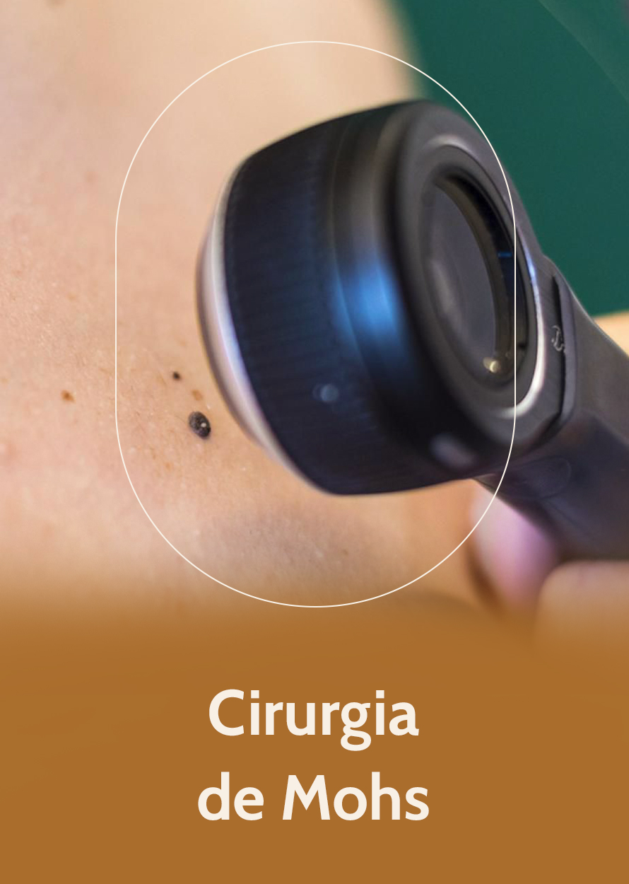 Imagem_CIRURGIA_MOHS